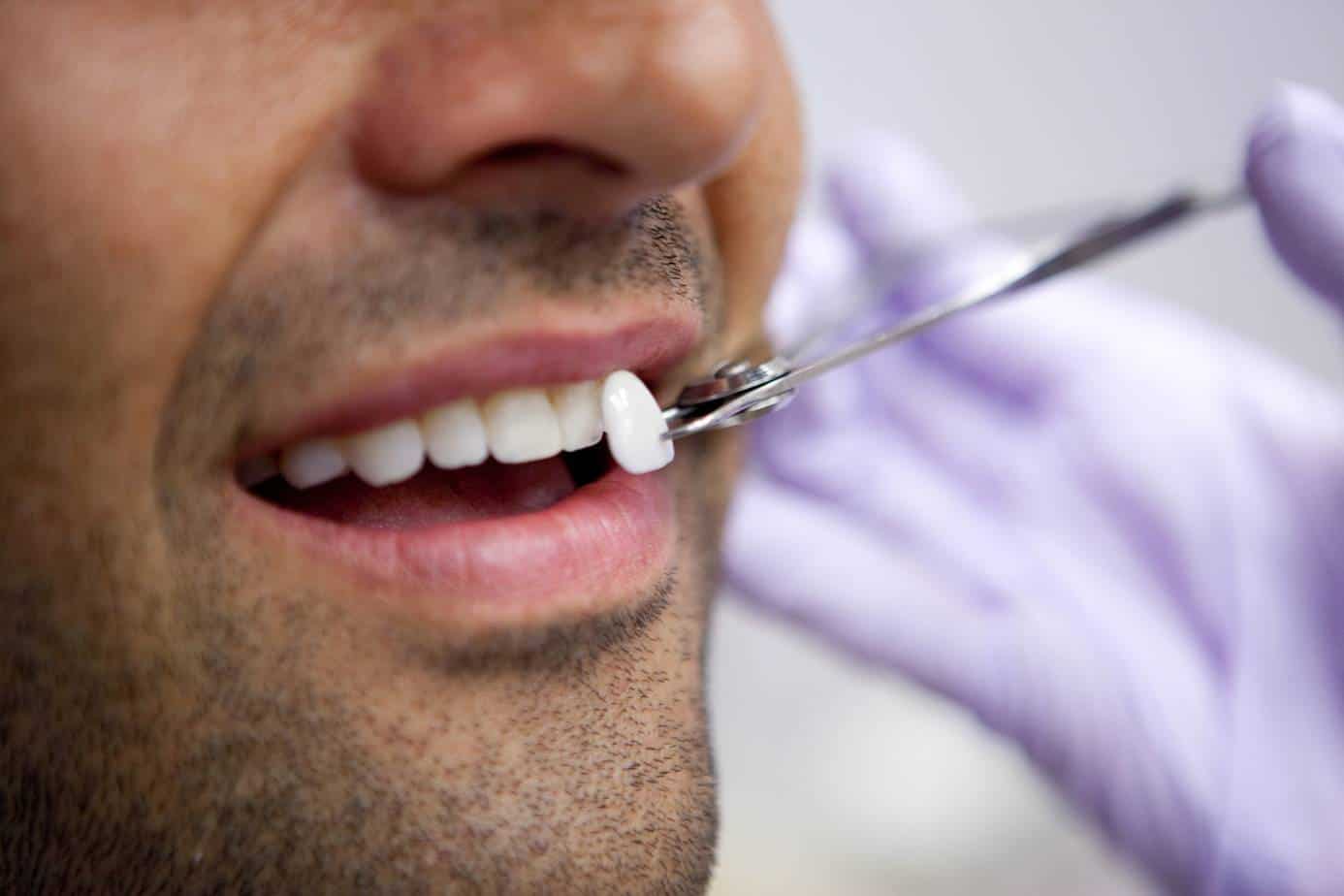 A man has a porcelain veneers fitted on one of his front teeth.