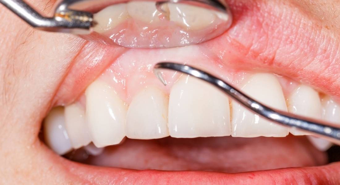 How do I prevent Gum Disease?