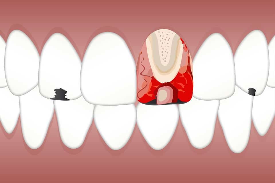 An illustration of the interior of a tooth.