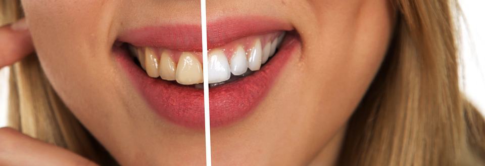 An illustration of before and after teeth whitening.