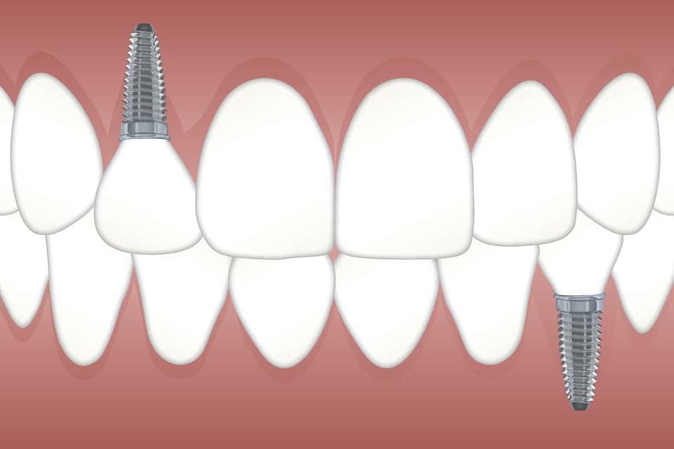 Q&A: Dental Implants