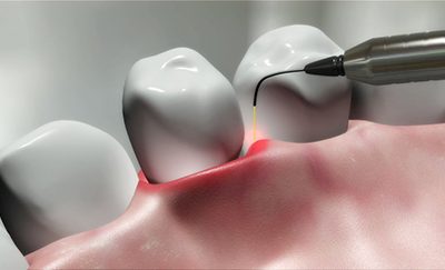 What’s the deal with the laser dental trend right now?