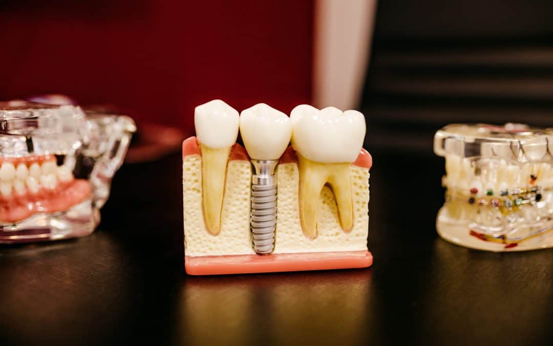 Why dental implants can be your best option